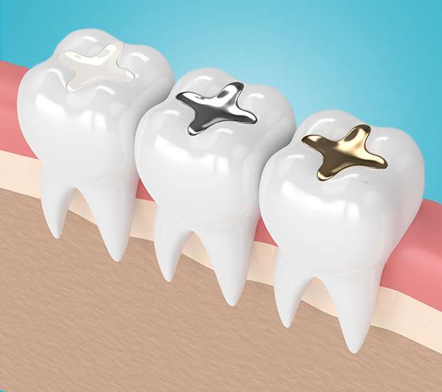 What Are Composite Dental Fillings, and Why Do You Need Them? : Santa  Monica Bay Dental: Dentists